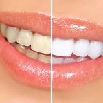 In-Office Teeth Whitening