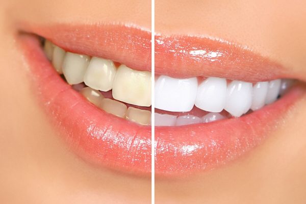 In-Office Teeth Whitening